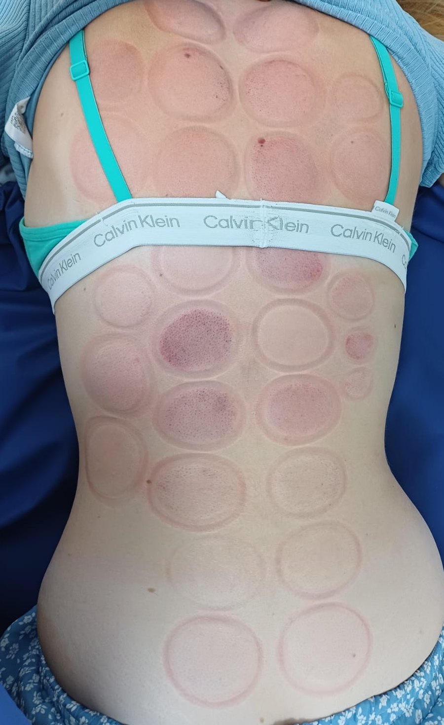A patient's back after cupping, showing pale, faintly marked circles across the upper back and lower back, and a band of dense dark marks at the lower thoracic region just to the right of the spine
