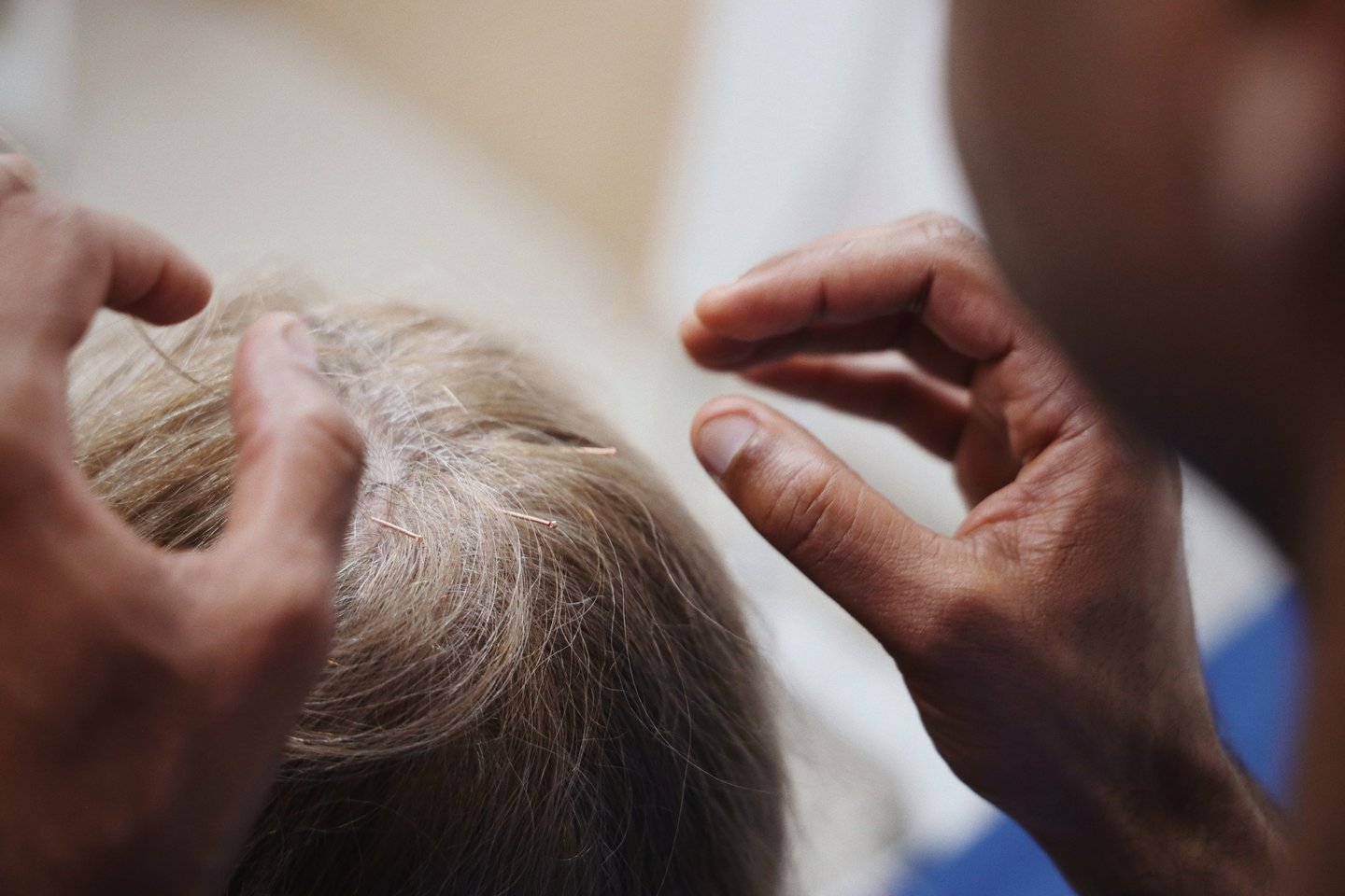 Dr Shehan placing a fine acupuncture needle in a patient's scalp